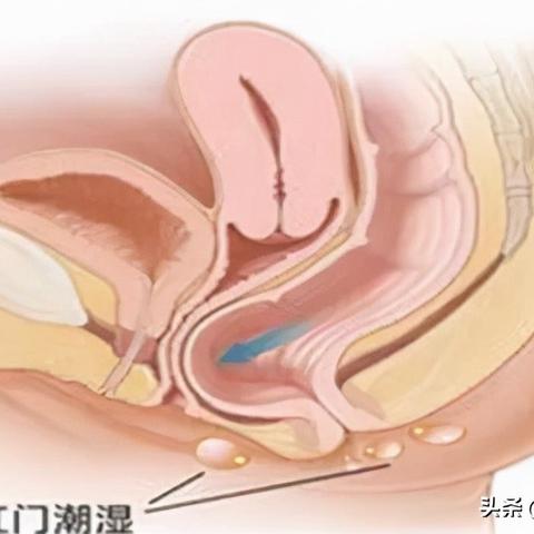 痔疮详解，从百度搜索角度，全面了解应对常见疾病痔疮