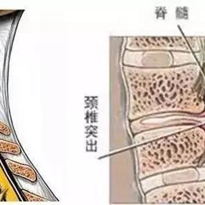 百度关键词解析揭秘，颈椎狭窄的深层含义与应对策略