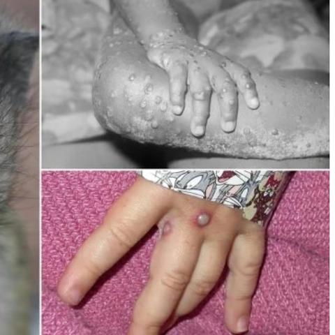 天津猴痘疑似事件最新视频报道，真相揭晓时刻！